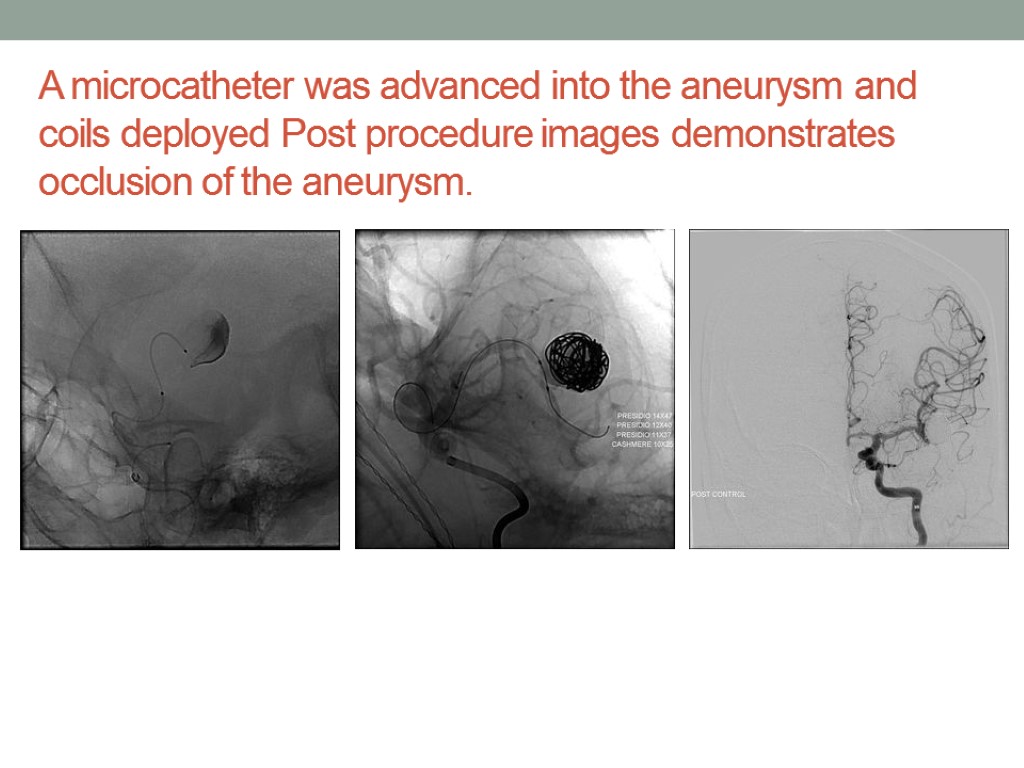 A microcatheter was advanced into the aneurysm and coils deployed Post procedure images demonstrates